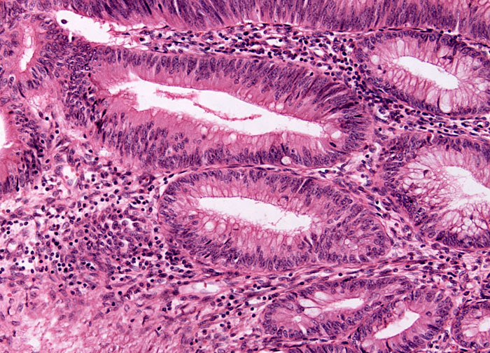 Высокодифференцированная эндометрия. Аденокарцинома толстой кишки гистология. Аденокарцинома Толстого кишечника гистология. Высокодифференцированная аденокарцинома гистология. Муцинозная аденокарцинома толстой кишки гистология.