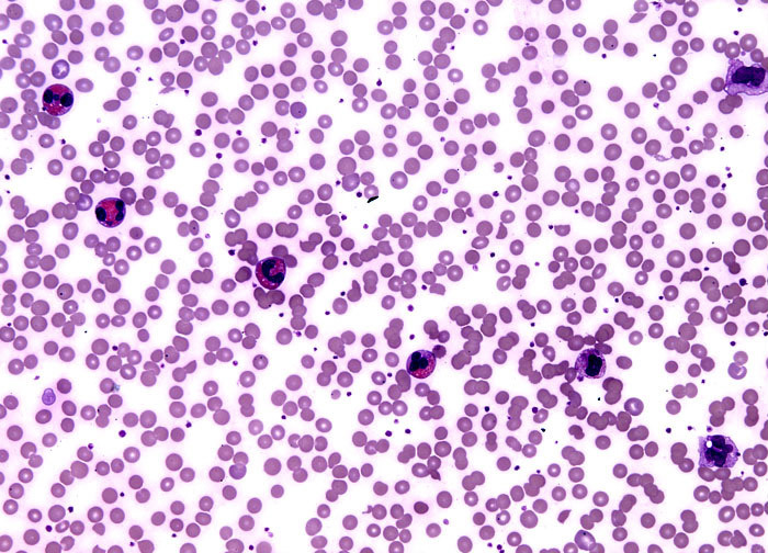 Eosinophil Under Light Microscope Eosinophil Under Light Microscope