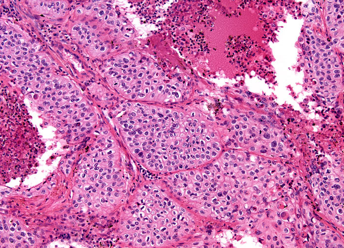 Lung Epidermoid Carcinoma At 10x Magnification Nikons Microscopyu