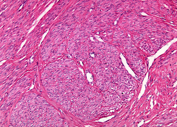 Uterine Leiomyoma at 10x Magnification | Nikon’s MicroscopyU