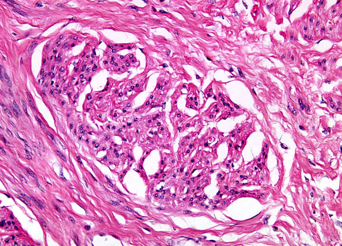 Uterine Leiomyoma at 20x Magnification | Nikon’s MicroscopyU