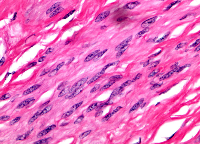 Uterine Leiomyoma at 40x Magnification | Nikon’s MicroscopyU