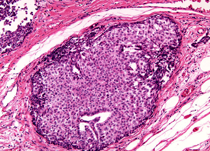 first presentation of metastatic lymphoma