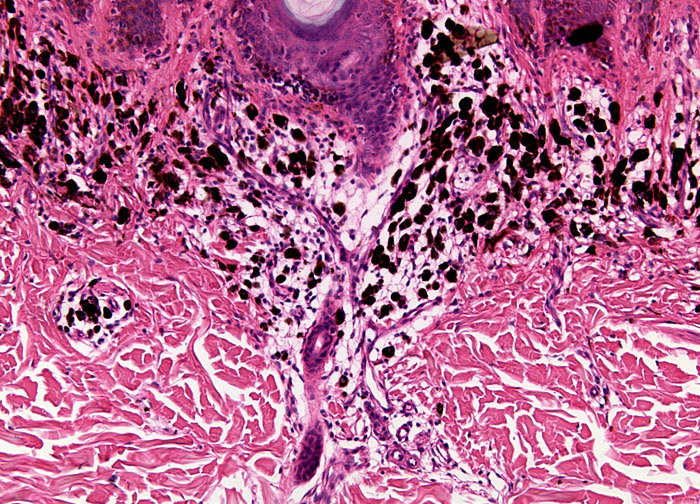 Malignant Melanoma At 10x Magnification Nikons Microscopyu