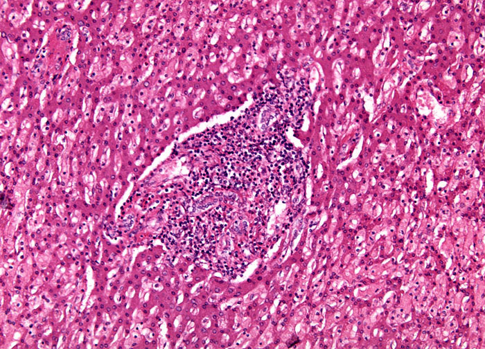 metastatic cancer of the liver