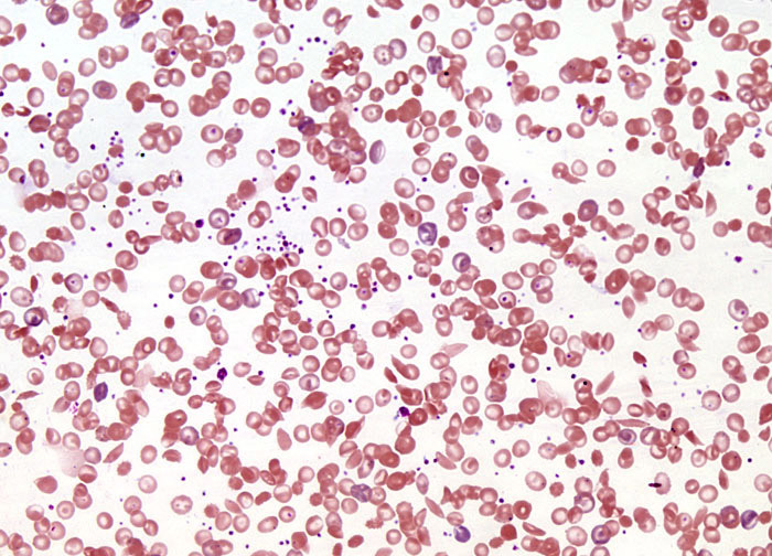 Sickle Cell Anemia at 20x Magnification | Nikon's MicroscopyU
