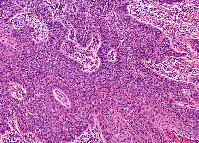 Laryngeal Squamous Cell Carcinoma At 10x Magnification Nikons